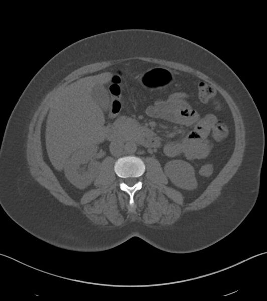 File:Calcified hepatic hydatid cyst (Radiopaedia 81127-94738 Axial non-contrast 45).jpg