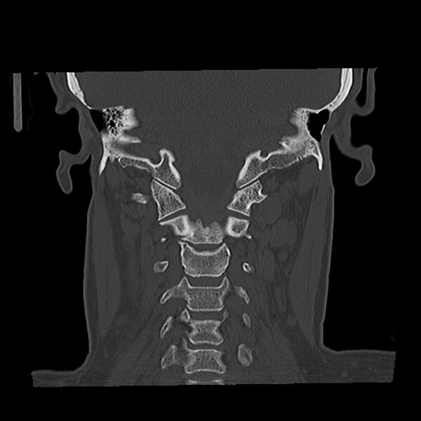 File:Canal up mastoidectomy (Radiopaedia 78108-90638 Coronal bone window 41).jpg