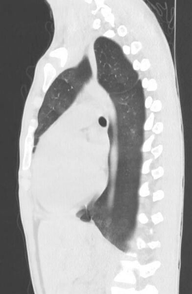 File:Cannabis-induced diffuse alveolar hemorrhage (Radiopaedia 89834-106946 Sagittal lung window 79).jpg