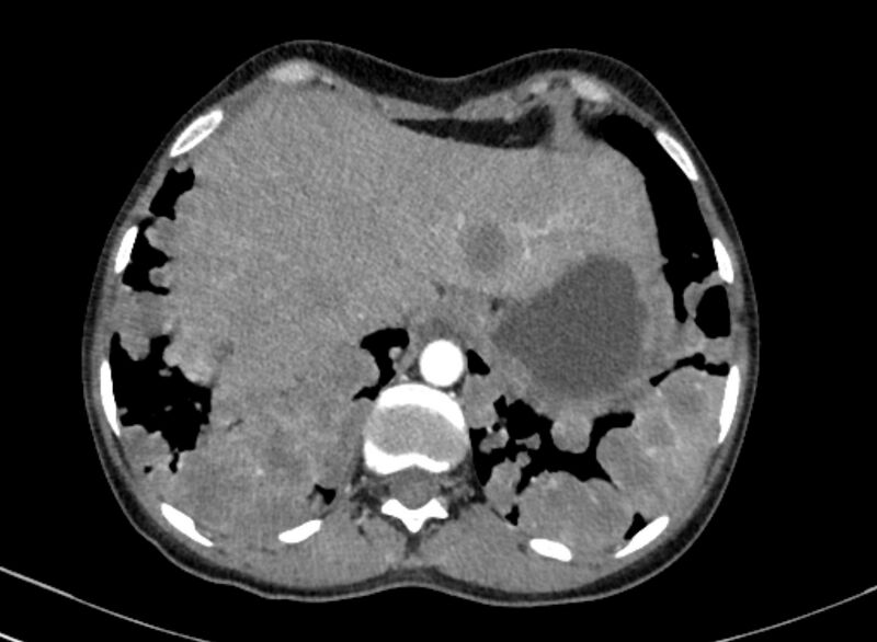 File:Cannonball metastases from breast cancer (Radiopaedia 91024-108569 A 104).jpg