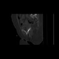 Carcinoma cervix- brachytherapy applicator (Radiopaedia 33135-34173 Sagittal bone window 70).jpg