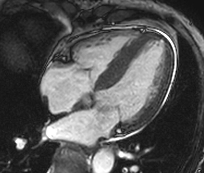 File:Cardiac amyloidosis (Radiopaedia 39736-42124 D 2).jpg