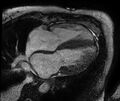 Cardiac amyloidosis (Radiopaedia 61600-69579 A 1).jpg