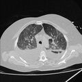 Cardiogenic pulmonary edema (Radiopaedia 29213-29609 Axial lung window 25).jpg