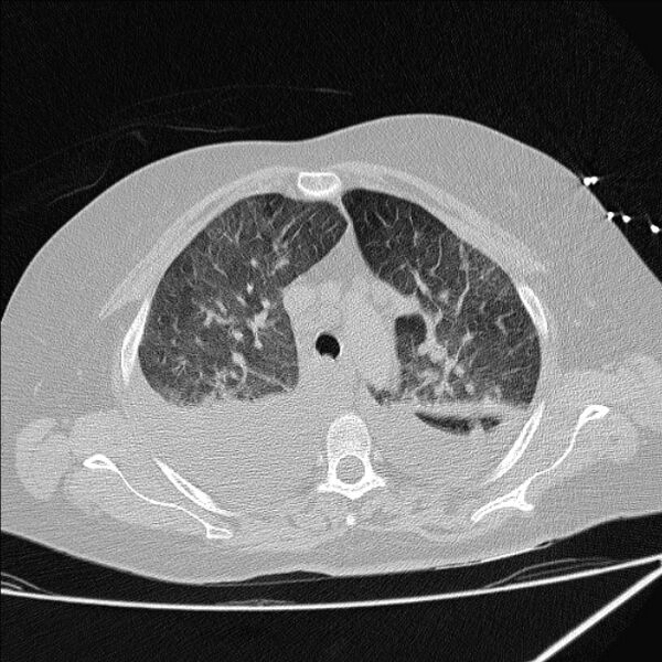 File:Cardiogenic pulmonary edema (Radiopaedia 29213-29609 Axial lung window 25).jpg