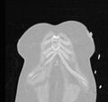 Cardiogenic pulmonary edema (Radiopaedia 29213-29609 Coronal lung window 2).jpg