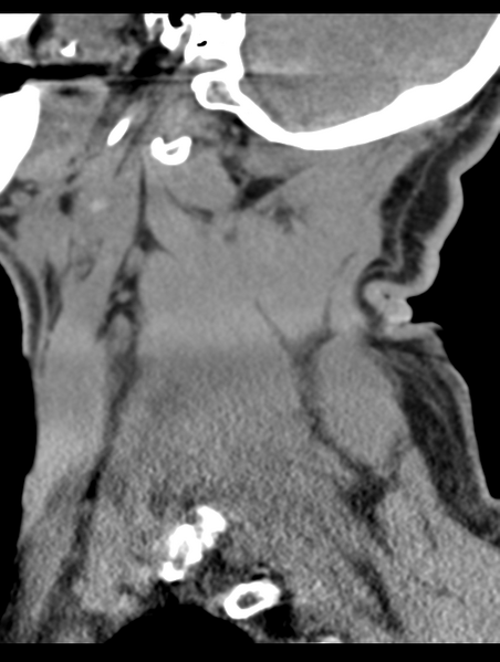 File:Cavernoma of cervical cord (Radiopaedia 50838-56346 B 16).png