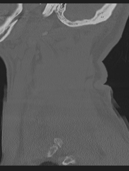 File:Cavernoma of cervical cord (Radiopaedia 50838-56346 Sagittal bone window 68).png