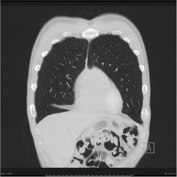 File:Cavitating lung cancer (Radiopaedia 25796-25945 lung window 7).jpg