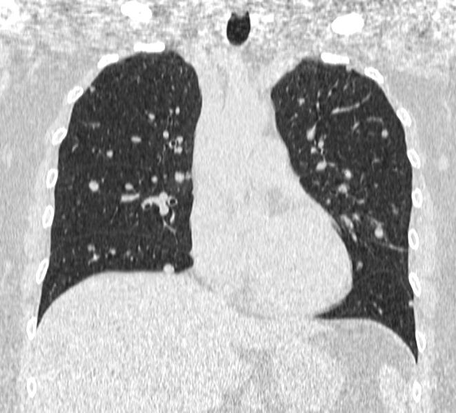 File:Cavitating pulmonary metastases (Radiopaedia 17796-17555 Coronal lung window 9).jpg