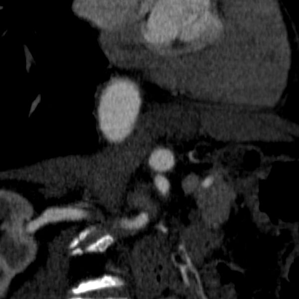 File:Celiac artery aneurysm (Radiopaedia 21574-21525 B 8).JPEG