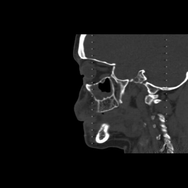 File:Cemento-ossifying fibroma (Radiopaedia 21243-21149 Sagittal bone window 13).jpg
