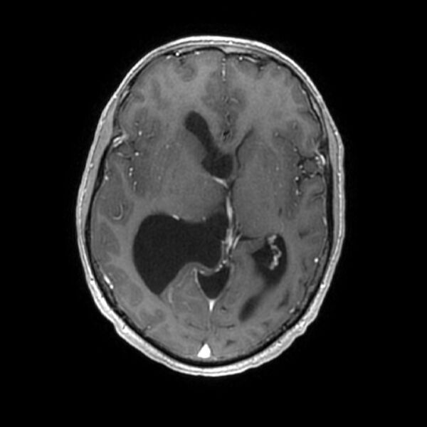 File:Central neurocytoma (Radiopaedia 67618-77021 Axial T1 C+ 13).jpg