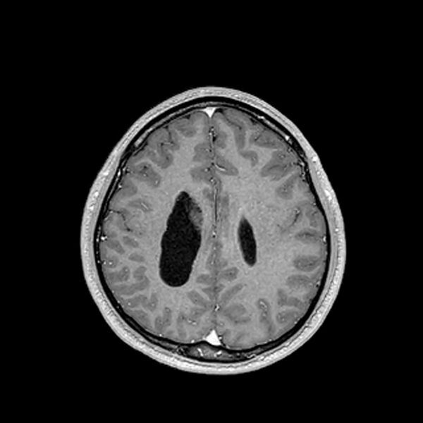 File:Central neurocytoma (Radiopaedia 79320-92380 Axial T1 C+ 169).jpg