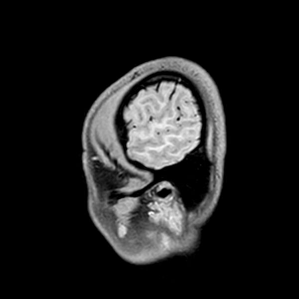 File:Central neurocytoma (Radiopaedia 79320-92380 Sagittal T1 235).jpg