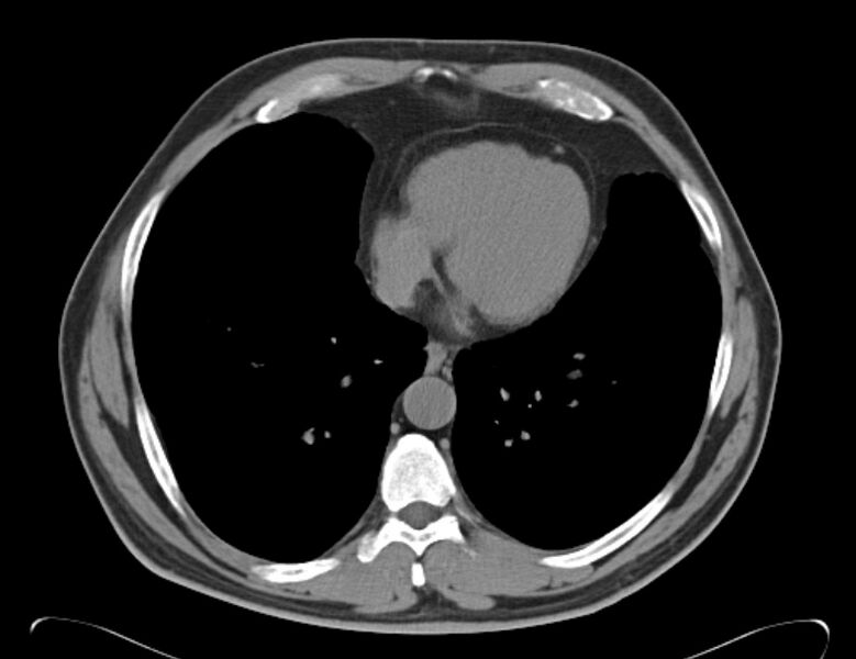 File:Centrilobular pulmonary emphysema (Radiopaedia 26808-26971 Axial non-contrast 31).jpg