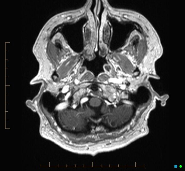 File:Cerebellar gangliocytoma (Radiopaedia 65377-74422 Axial T1 C+ 1).jpg