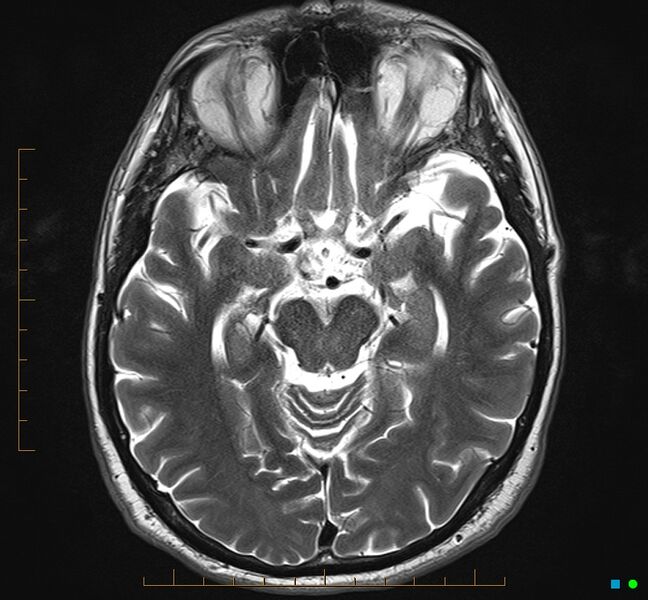 File:Cerebellar gangliocytoma (Radiopaedia 65377-74422 Axial T2 15).jpg