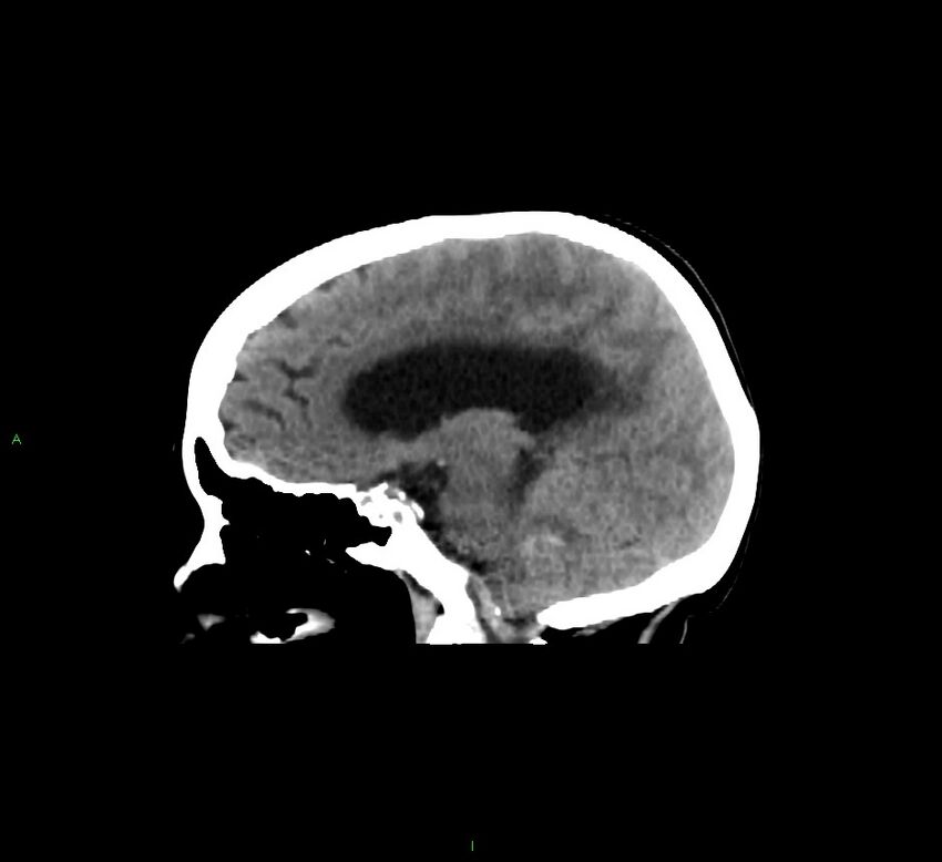 Cerebellar hemorrhage (Radiopaedia 58793-66027 C 30).jpg