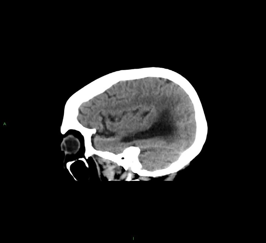 Cerebellar hemorrhage (Radiopaedia 58793-66027 C 39).jpg
