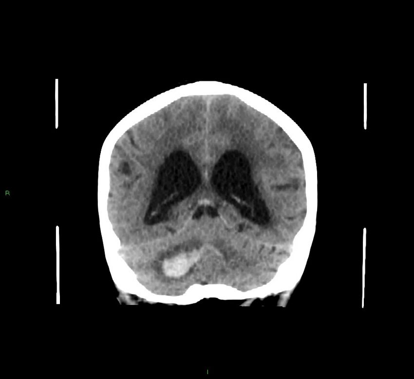 Cerebellar hemorrhage (Radiopaedia 58793-66027 Coronal non-contrast 26).jpg