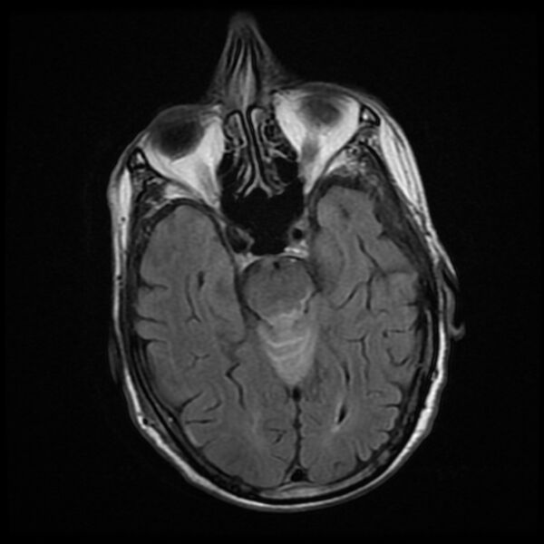 File:Cerebellar metastasis - lung tumor (Radiopaedia 69317-79147 Axial FLAIR 13).jpg