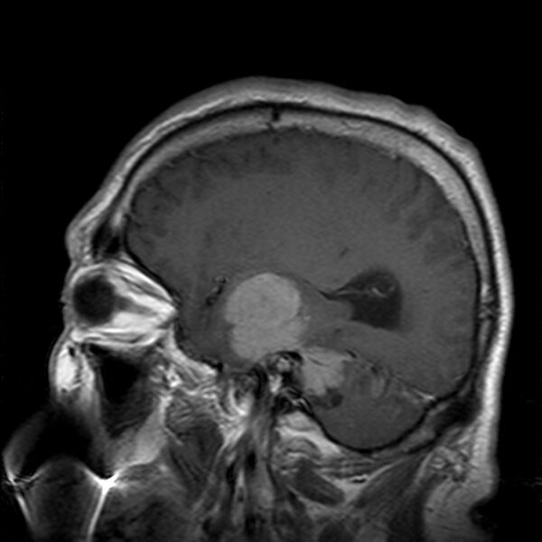 File:Cerebellopontine angle meningioma (Radiopaedia 24459-24764 Sagittal T1 C+ 7).jpg
