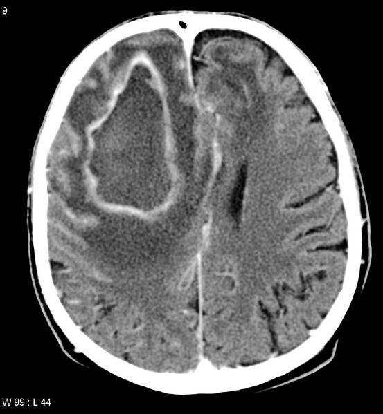 File:Cerebral abscesses secondary to contusions (Radiopaedia 5201-6967 Axial C+ delayed 4).jpg
