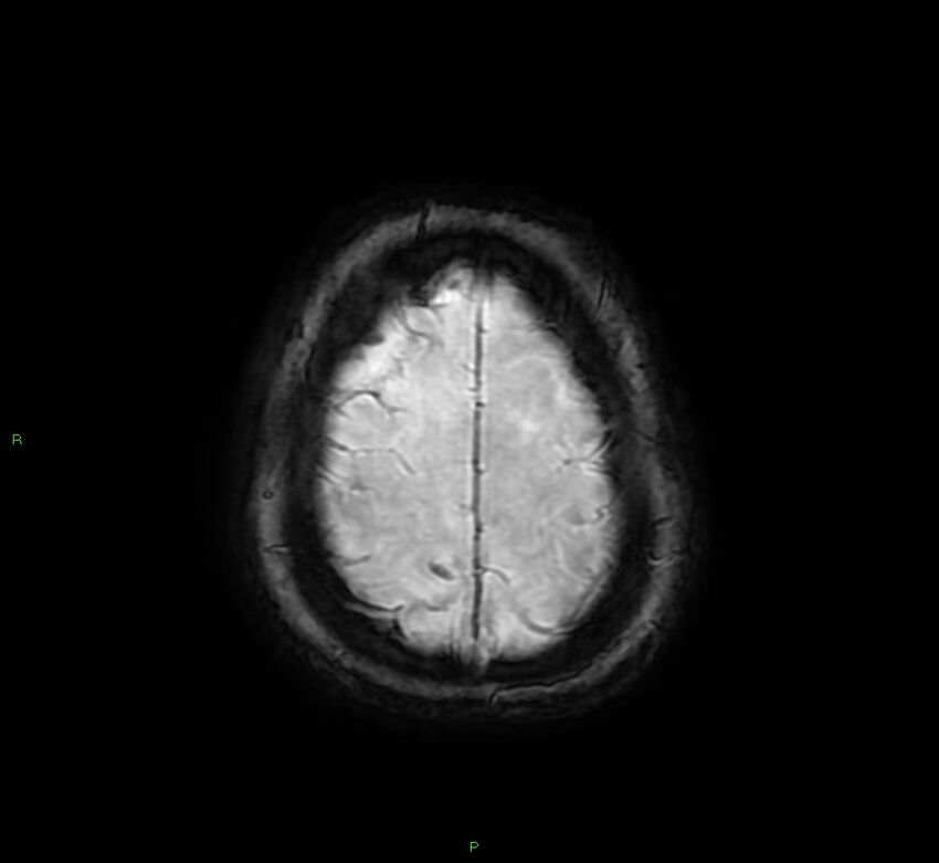Cerebral amyloid angiopathy-associated lobar intracerebral hemorrhage (Radiopaedia 58378-65517 Axial SWI 64).jpg