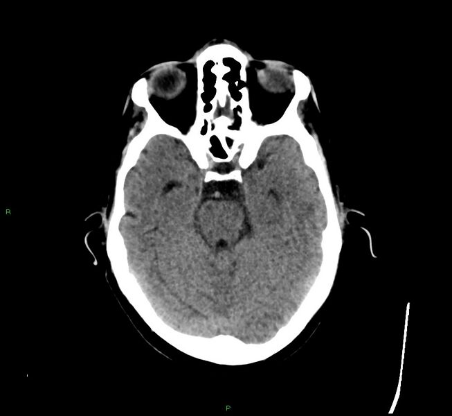 File:Cerebral amyloid angiopathy-associated lobar intracerebral hemorrhage (Radiopaedia 58529-65681 Axial non-contrast 35).jpg