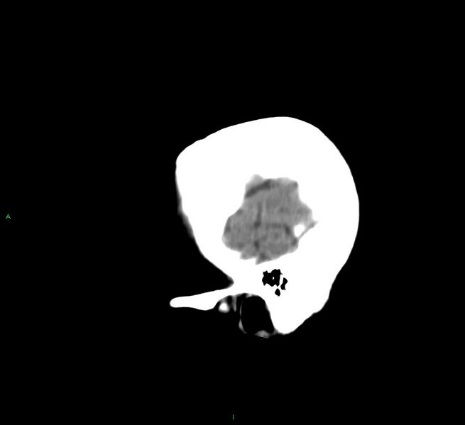 File:Cerebral amyloid angiopathy-associated lobar intracerebral hemorrhage (Radiopaedia 58530-65688 C 49).jpg