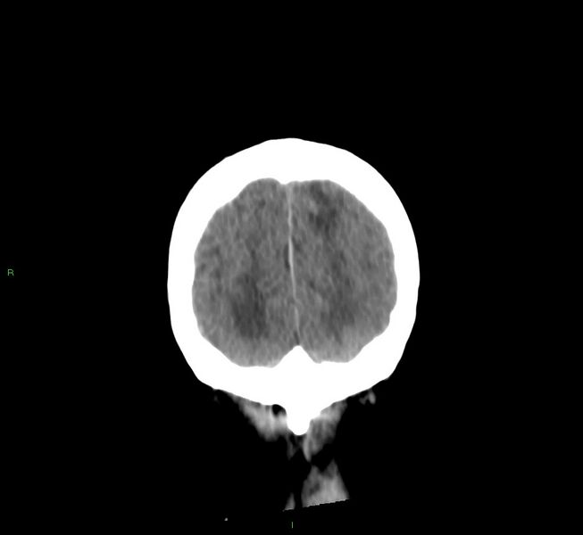 File:Cerebral amyloid angiopathy-associated lobar intracerebral hemorrhage (Radiopaedia 58530-65688 Coronal non-contrast 11).jpg