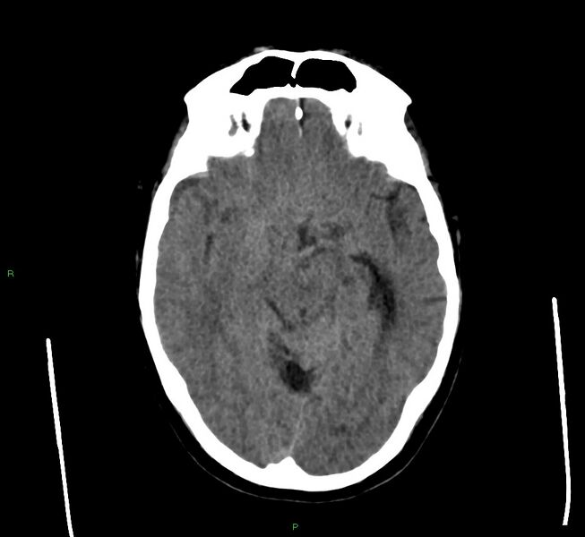File:Cerebral amyloid angiopathy-associated lobar intracerebral hemorrhage (Radiopaedia 58560-65723 Axial non-contrast 33).jpg
