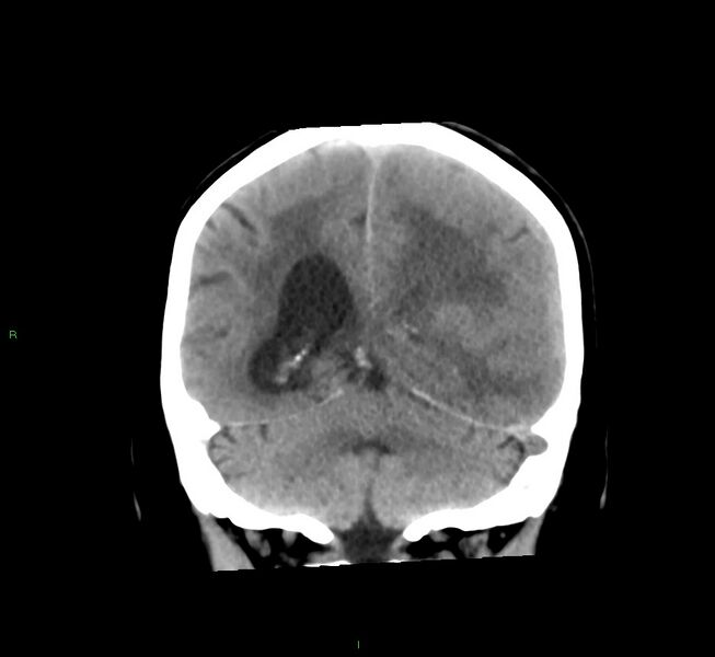 File:Cerebral amyloid angiopathy-associated lobar intracerebral hemorrhage (Radiopaedia 58561-65724 Coronal non-contrast 23).jpg