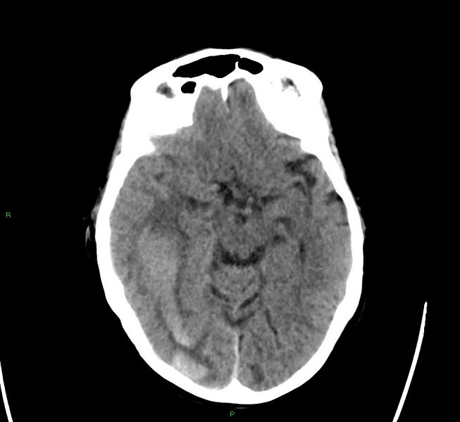 File:Cerebral amyloid angiopathy-associated lobar intracerebral hemorrhage (Radiopaedia 58563-65727 Axial non-contrast 34).jpg