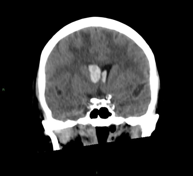 File:Cerebral amyloid angiopathy-associated lobar intracerebral hemorrhage (Radiopaedia 58566-65730 Coronal non-contrast 43).jpg