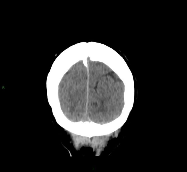 File:Cerebral amyloid angiopathy-associated lobar intracerebral hemorrhage (Radiopaedia 58756-65977 Coronal non-contrast 11).jpg