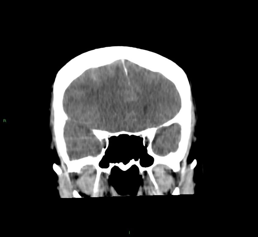 Cerebral amyloid angiopathy-associated lobar intracerebral hemorrhage (Radiopaedia 58756-65977 Coronal non-contrast 45).jpg