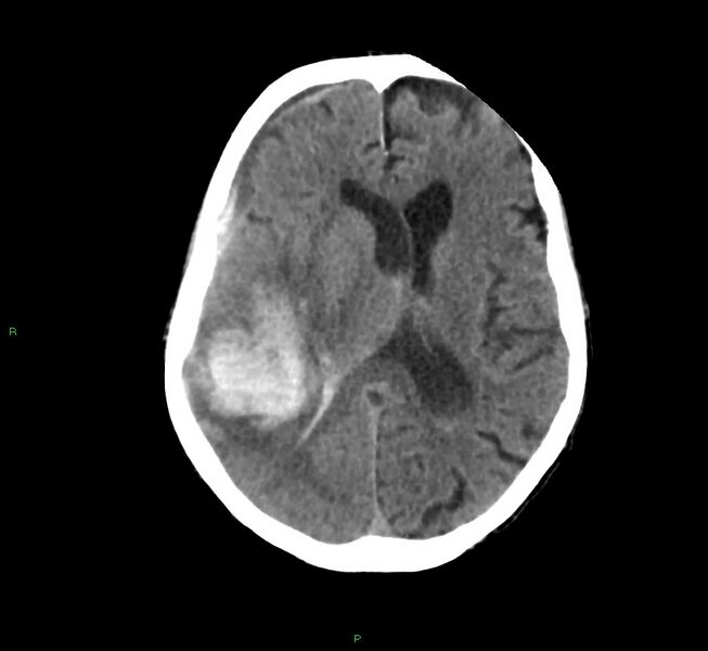 File:Cerebral amyloid angiopathy-associated lobar intracerebral hemorrhage (Radiopaedia 58758-65980 Axial non-contrast 23).jpg