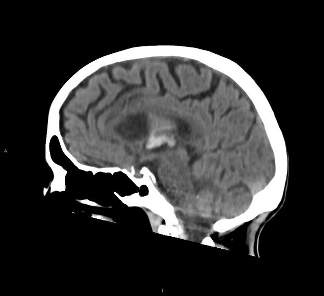 File:Cerebral amyloid angiopathy-associated lobar intracerebral hemorrhage (Radiopaedia 58758-65980 C 30).jpg