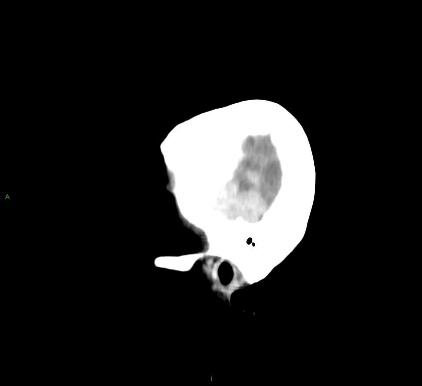Cerebral amyloid angiopathy-associated lobar intracerebral hemorrhage (Radiopaedia 58758-65980 C 6).jpg