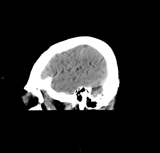 File:Cerebral amyloid angiopathy-associated lobar intracerebral hemorrhage (Radiopaedia 59356-66716 C 12).jpg