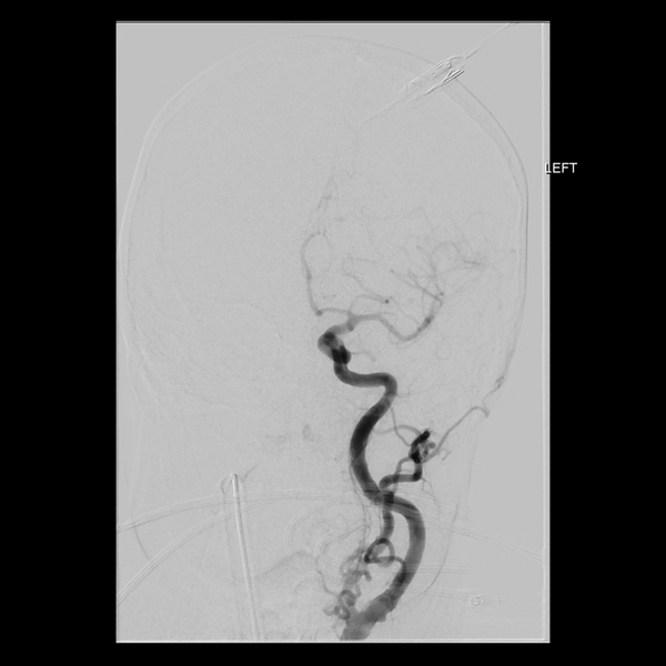 File:Cerebral arteriovenous malformation with lobar hemorrhage (Radiopaedia 44725-48513 LT CCA IC 11).png
