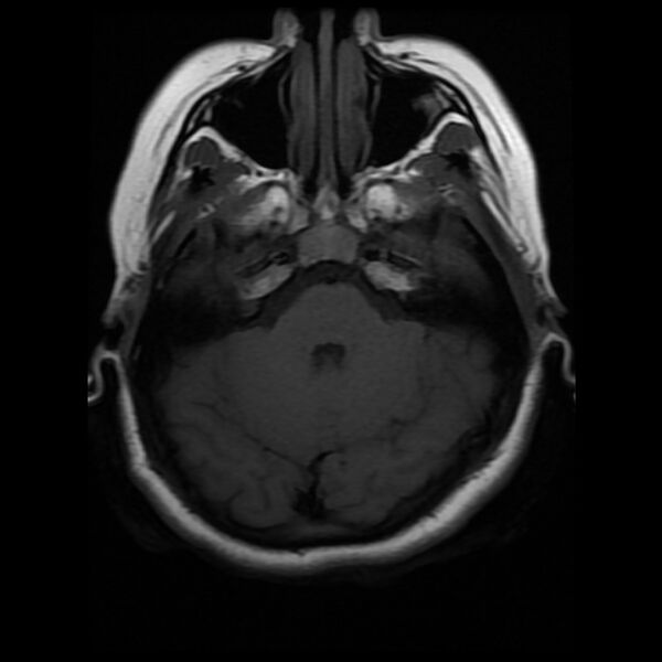 File:Cerebral cavernous malformation (Radiopaedia 44301-47942 Axial T1 6).jpg