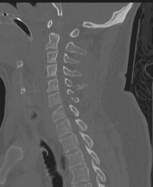 File:Cerebral hemorrhagic contusions and cervical spine fractures (Radiopaedia 32865-33841 Sagittal bone window 57).jpg