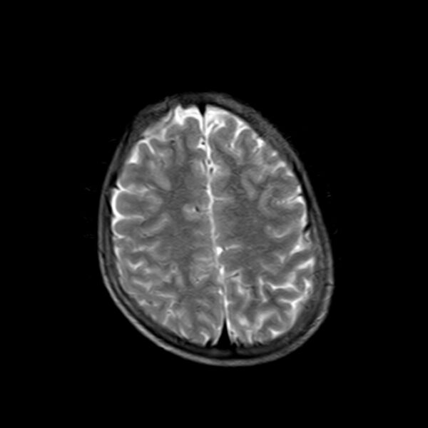 File:Cerebral tuberculoma (Radiopaedia 41152-43932 Axial T2 18).jpg