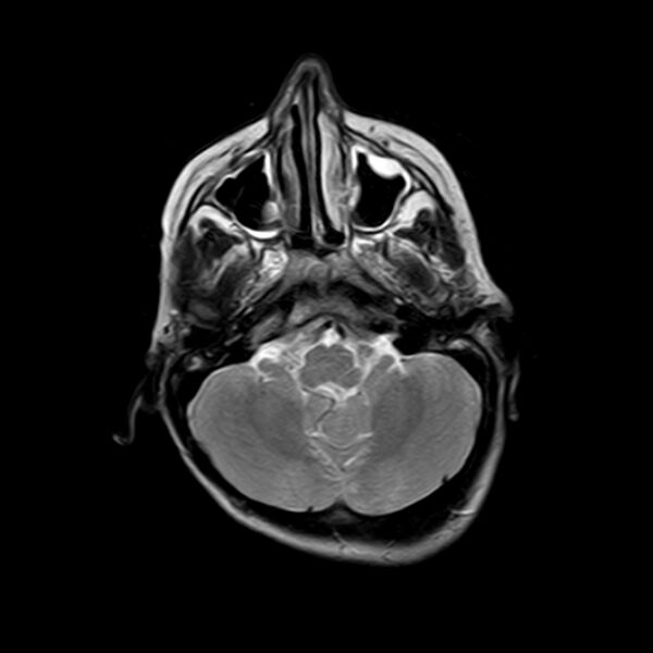 File:Cerebral tuberculoma (Radiopaedia 41152-43932 Axial T2 4).jpg