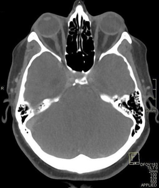 File:Cerebral venous sinus thrombosis (Radiopaedia 91329-108965 Axial venogram 27).jpg