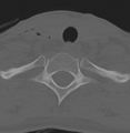 Cervical disc replacement (Radiopaedia 37383-39205 Axial bone window 19).png
