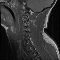 Cervical flexion teardrop fracture with cord hemorrhage (Radiopaedia 32497-33455 Sagittal T1 4).jpg